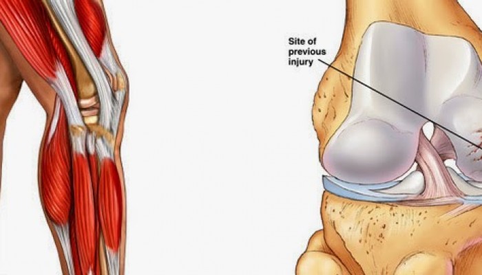 Phương pháp trị liệu đau khớp gối phổ biến nhất