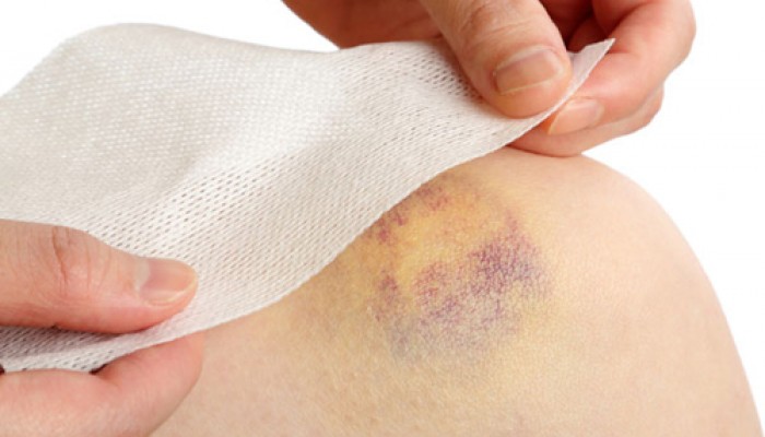 Cách làm tan máu bầm hiệu quả và đơn giản