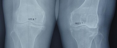 Tất cả về đau khớp gối (P4)